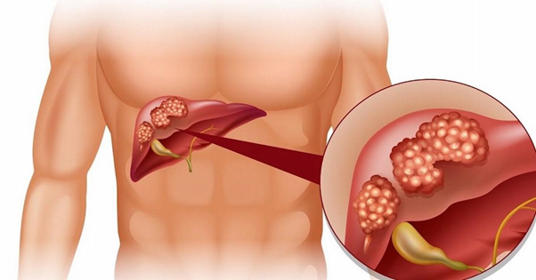 tác hại của tỏi ngâm mật ong 