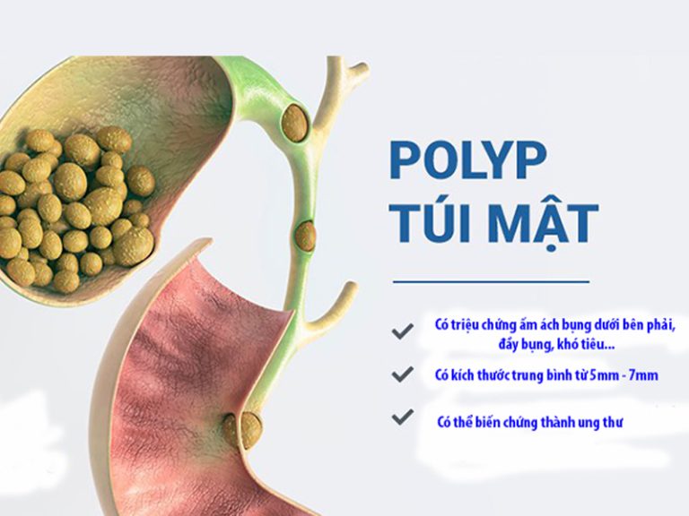 polyp túi mật