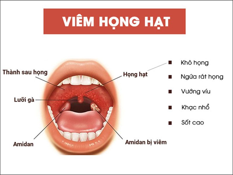 viêm họng hạt