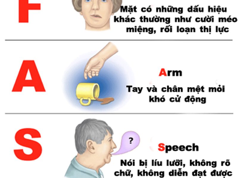  dấu hiệu đột quỵ