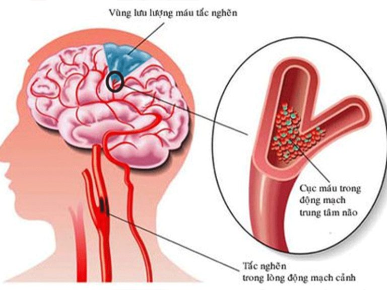 dấu hiệu đột quỵ