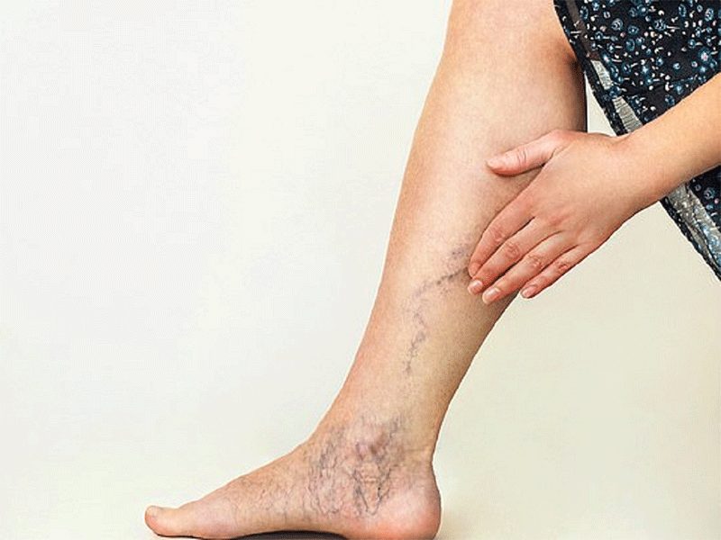 Giãn tĩnh mạch - Nguyên nhân, triệu chứng và phương pháp điều trị hiệu quả Giãn tĩnh mạch – Nguyên nhân, triệu chứng và phương pháp điều trị hiệu quả