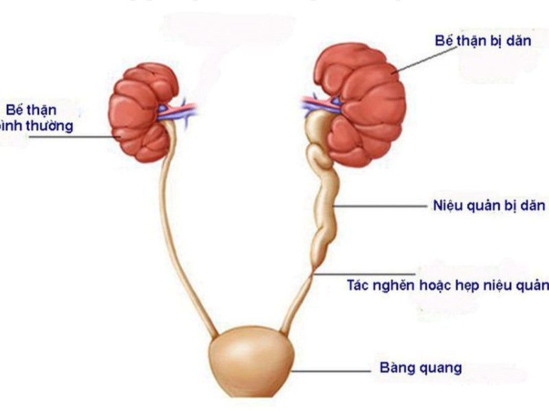 thận ứ nước