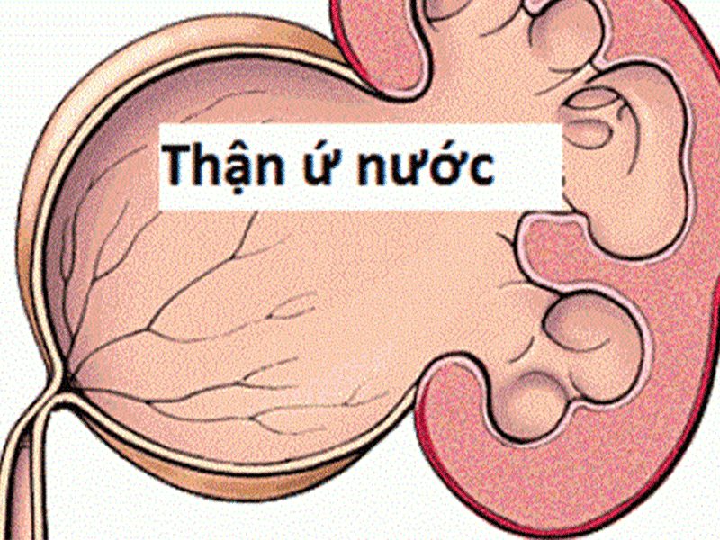 thận ứ nước