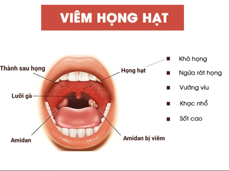 viêm họng mãn tính