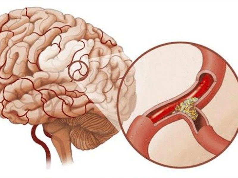 xuất huyết não 