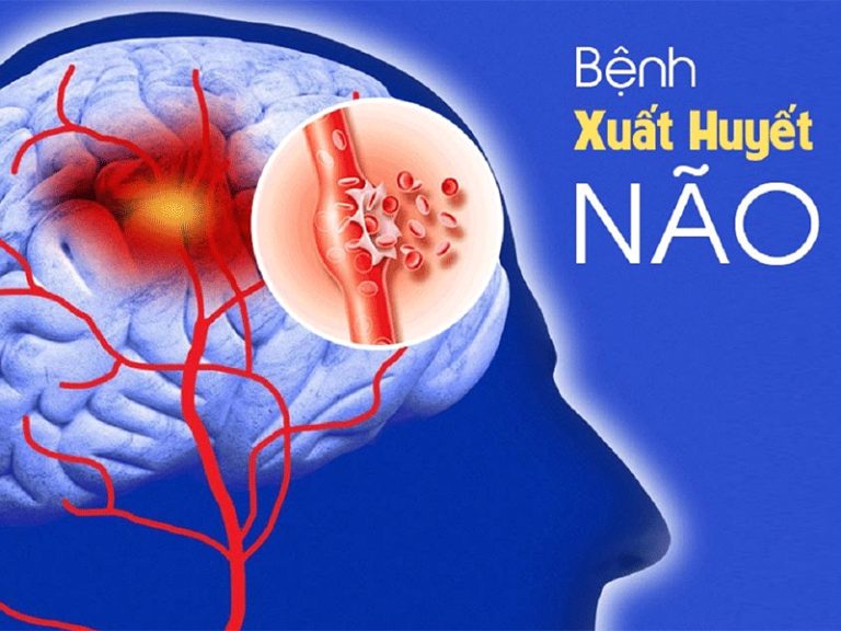 xuất huyết não