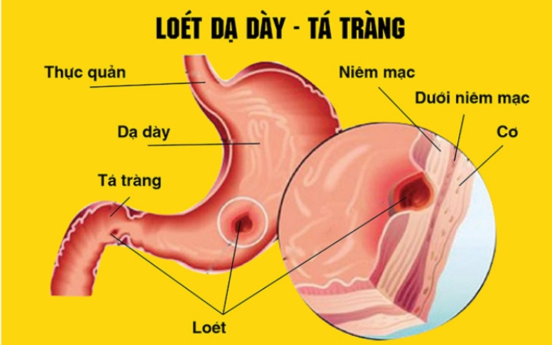 Mật ong Manuka là gì?